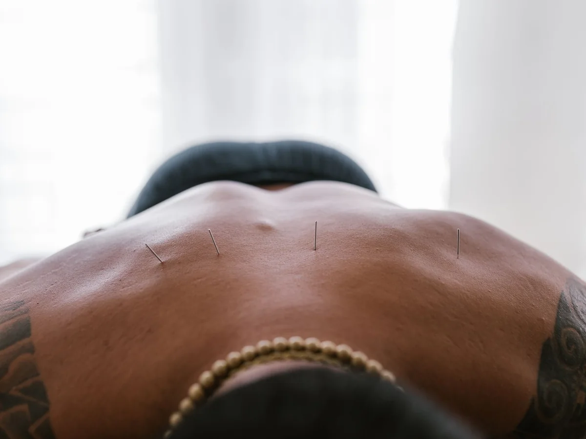 Acupuncture needles placed along a person’s back during a treatment session